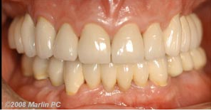 Implant Rejuvenation of the Jaw After