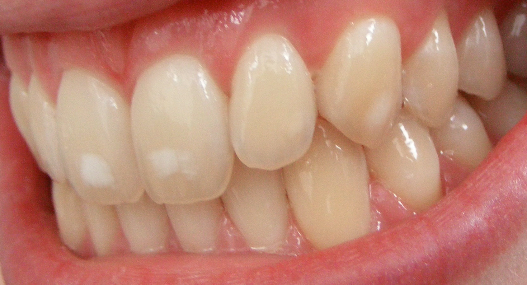 calcium deficiency spots on teeth