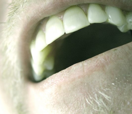 The Stink on Halitosis