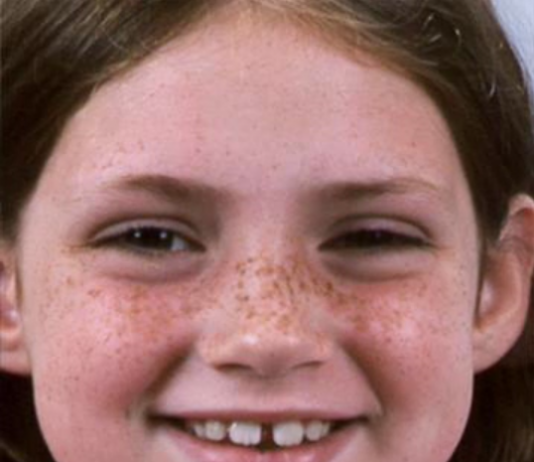 What results can orthodontic braces deliver for my child’s smile? See for yourself…