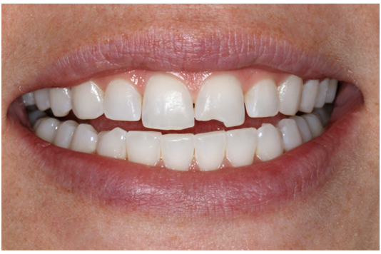 What are my options for repairing a chipped tooth?