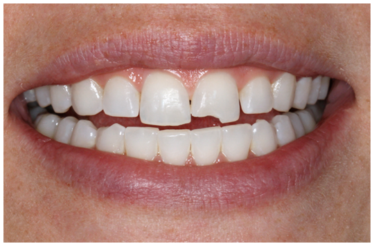 Veneers Burnaby Dentist. We offer bonding, crowns, bridges, dental implants and veneers in Burnaby, BC.