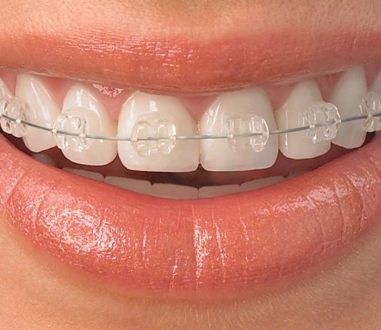 If Adults think orthodontic braces are only for kids, think again.