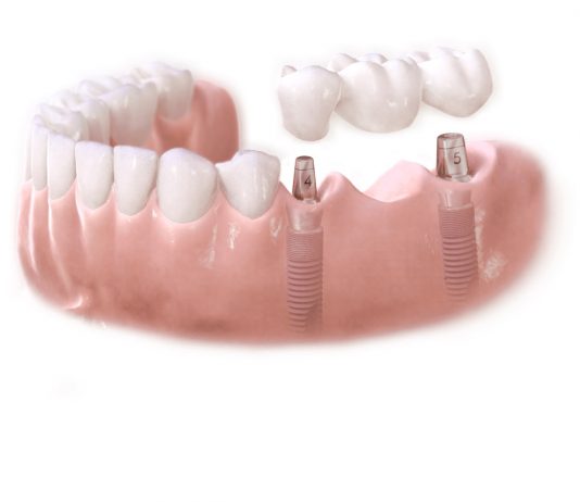 If I’m missing multiple teeth, what are my dental treatment options?