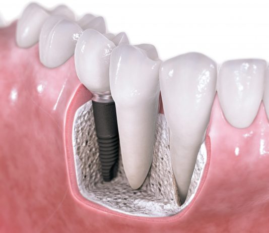 Can dental implants reverse the impact of periodontal disease?