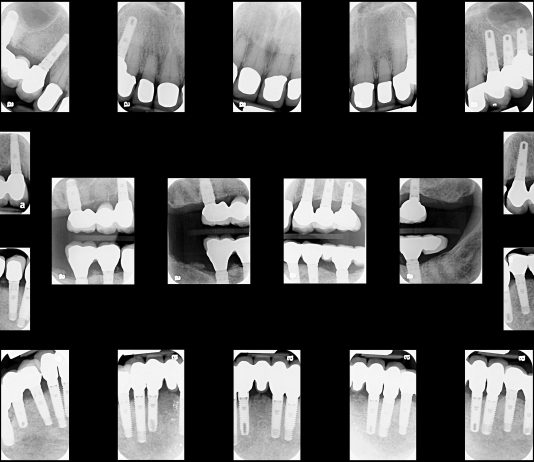 Can Dental Implants Provide Added Jaw Stability?