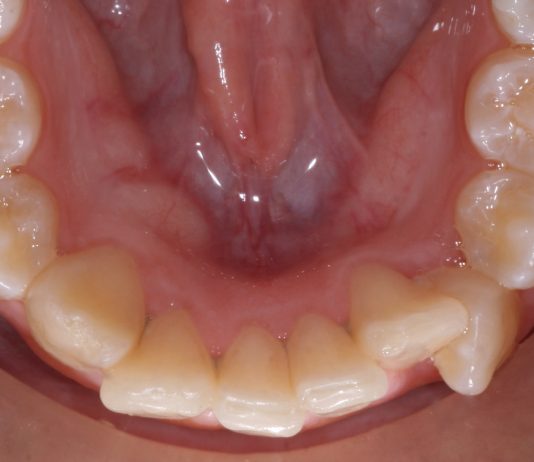 What Can Be Done to Correct ‘Crowding of the Teeth’?