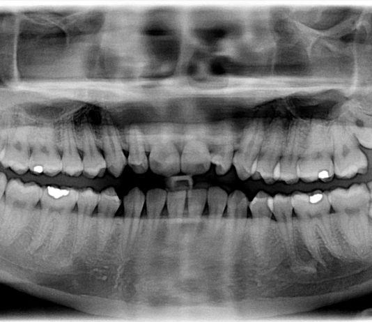 3 Signs Your Wisdom Teeth Need to Go