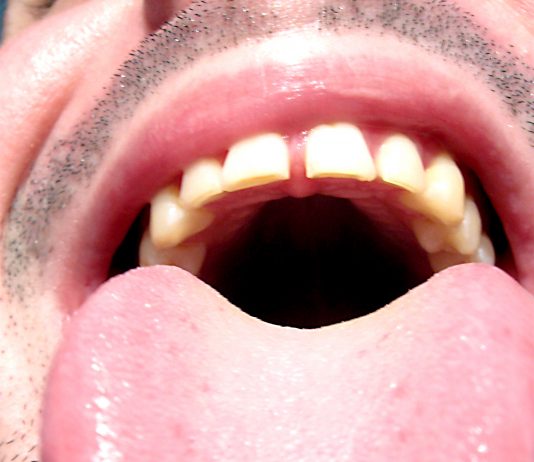 Tongue Discoloration