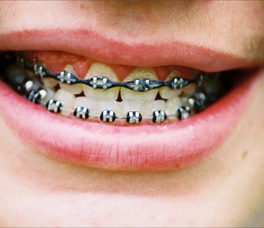 How Should I Brush My Teeth When I Have Braces?