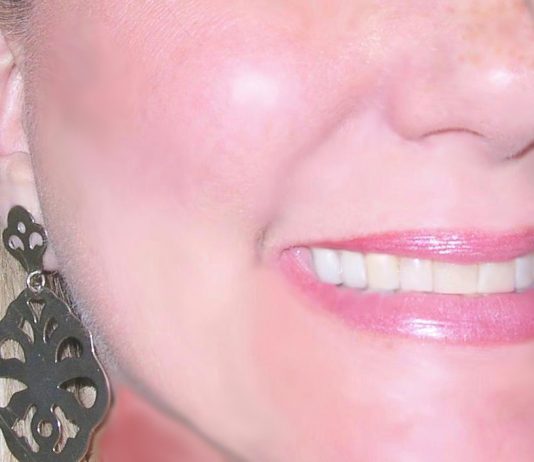 What Is Intrinsic Tooth Discoloration?