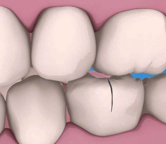 How Can Tooth Bonding Improve My Smile?
