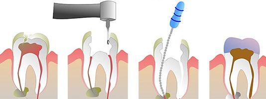 Top Signs That You May Need a Root Canal