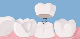 How Durable Are Dental Crowns?