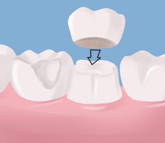 How Durable Are Dental Crowns?