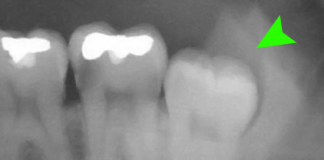 Is Wisdom Tooth Removal Necessary?