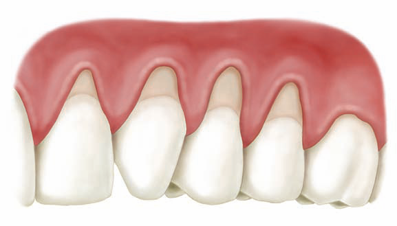 Gingival Surgery for Significant Gum Recession