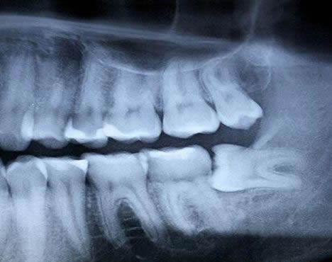 Image result for impacted wisdom tooth xray