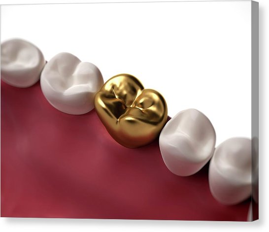 When Is Gold Used in Dentistry?