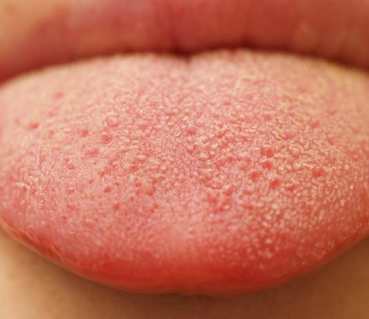 What Is Oral Thrush and Who Is at Risk for Getting It?