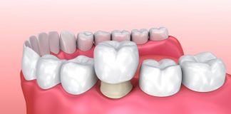 Can a Crown Fall Out? And What Should You Do If It Does?