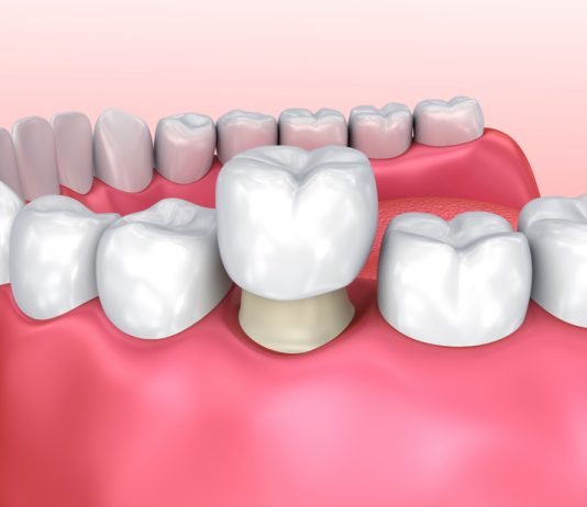 Why Are Temporary Crowns Necessary, and Will They Look Natural?