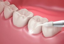 What Is Laser Dentistry, and When Is It Used?