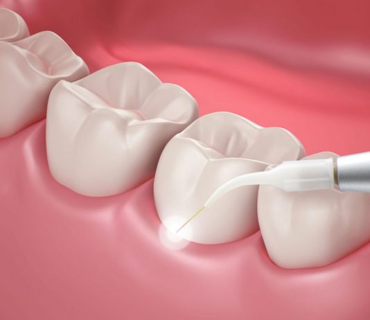 What Is Laser Dentistry, and When Is It Used?