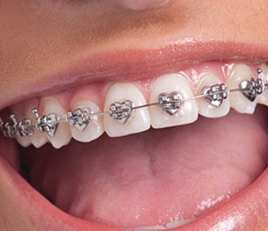 Make Your Child’s Orthodontic Treatment Fun with WildSmiles Braces