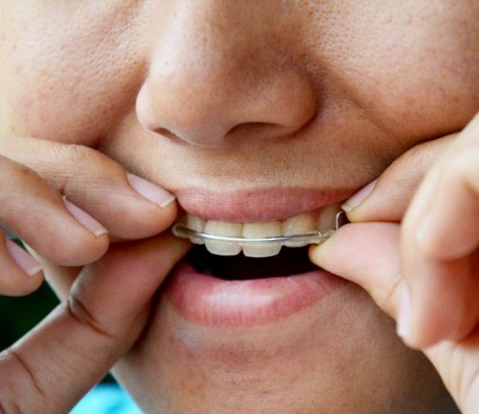 Do I Really Need to Wear My Retainer Forever? (And Why)