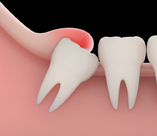 Does Everyone Need Their Wisdom Teeth Extracted?