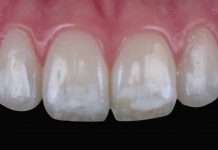 Do You Have White Spots on Your Teeth?