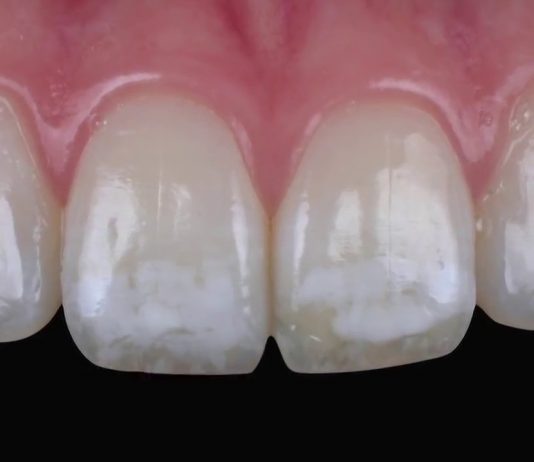 Do You Have White Spots on Your Teeth?