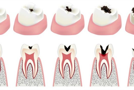 What Happens When You Ignore Cavities?