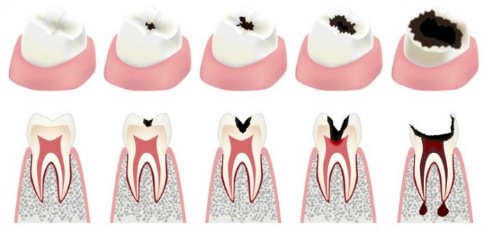 what-causes-cavities-diagram