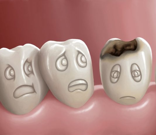 Top Causes of Cavities