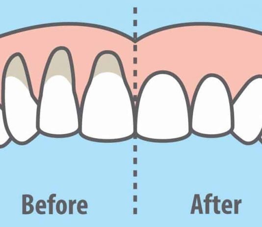 Can You Prevent Gum Recession?