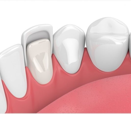 What Exactly Are Dental Veneers, and Are You a Good Candidate?