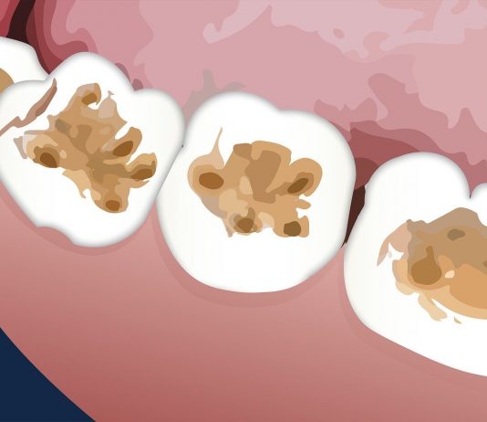 How Do Dentists Treat Decay Under Fillings?