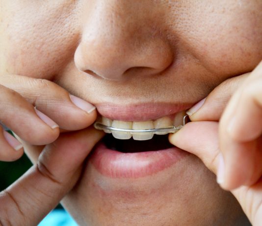 How Long Do You Have to Wear Retainer After Braces?