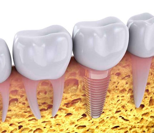 What Is Peri-Implantitis?