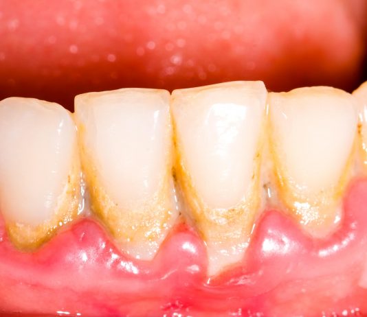 How Do Tartar and Plaque Harm Your Smile?
