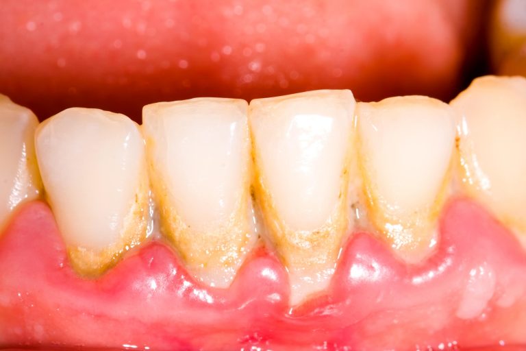 How Do Tartar and Plaque Harm Your Smile?