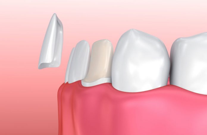 dental-veneers-e1569179633726