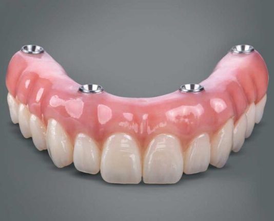 All-on-Four Dental Implants: The Denture Alternative