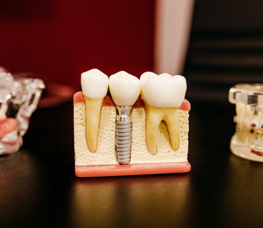 What Factors Might Contribute to Tooth Loss?