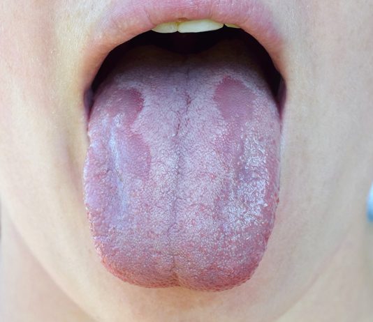 What Is Oral Thrush and How Is It Treated?