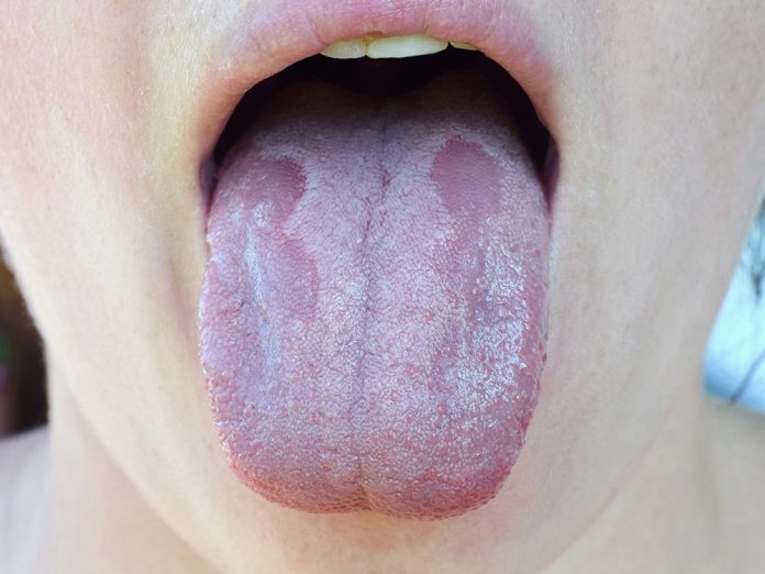 oral-thrush-narrow