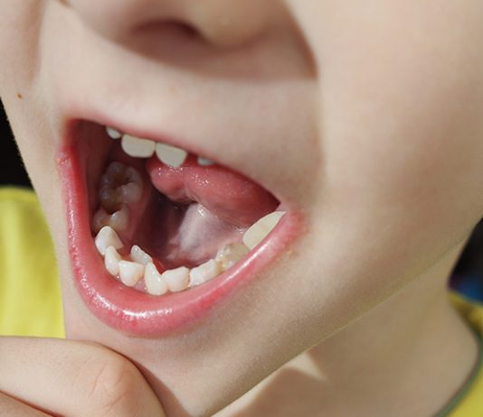 Hyperdontia: Fast Facts About Extra Teeth