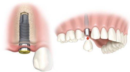 Dental Implants Can Restore Your Smile